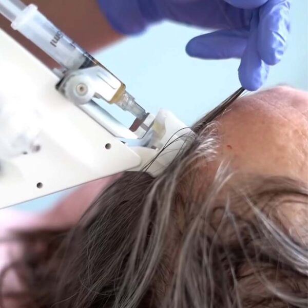 Traitement contre la perte de cheveux PRP – Image 3