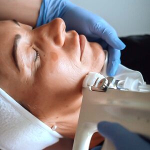Vampire Facial PRP