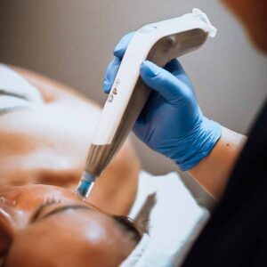 Microneedling